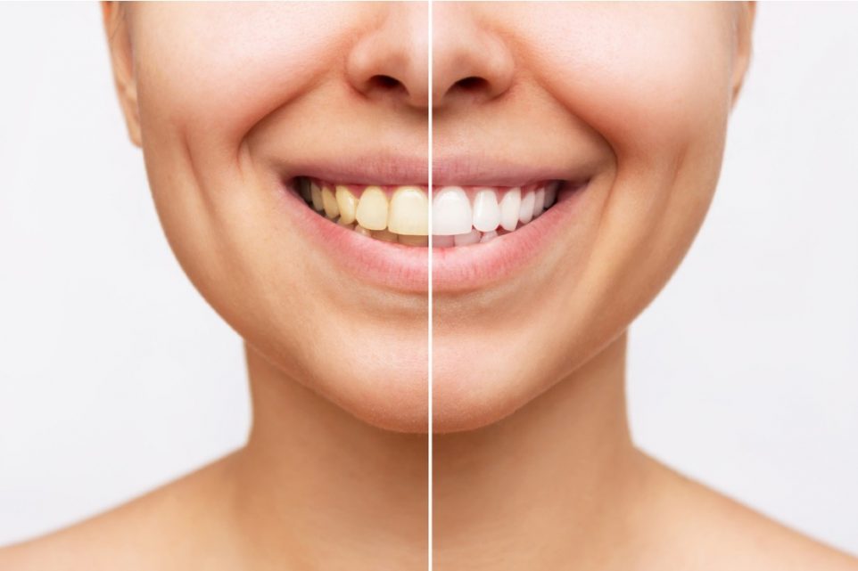 how much does it cost to whiten teeth