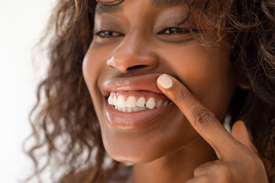 white spots on teeth