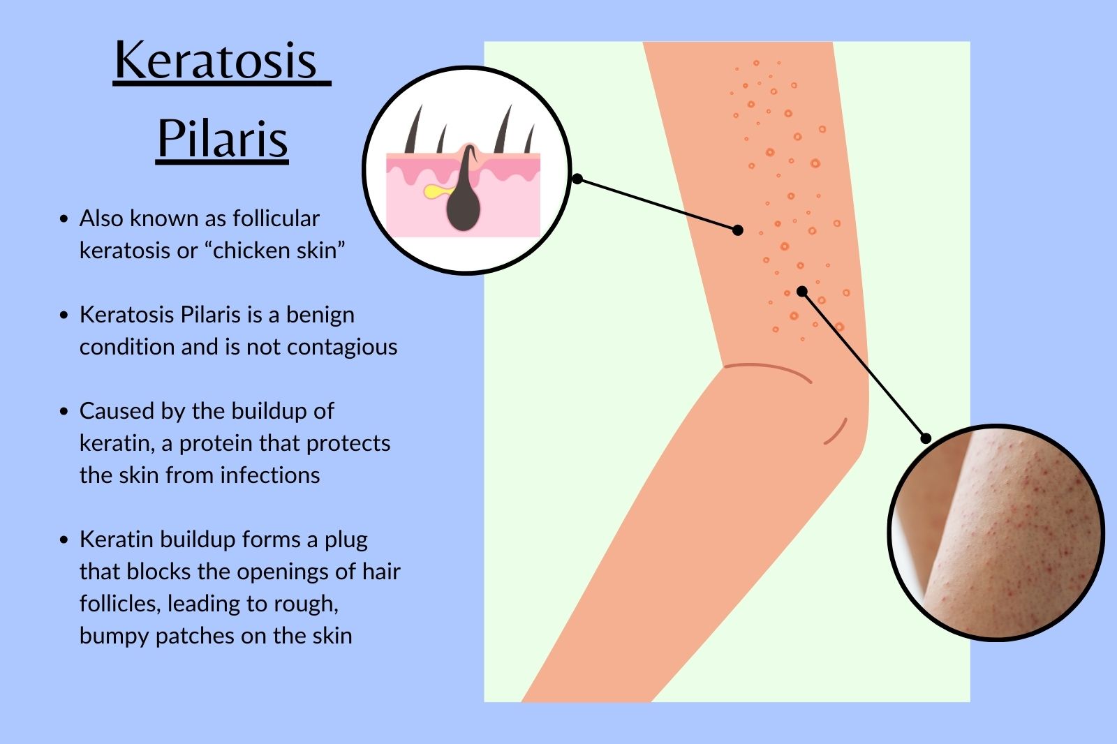 Infographic with important facts about keratosis pilaris